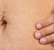 Estrías que salen después del embarazo. Internet