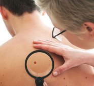 En Colombia la tasa de incidencia de melanoma es de tres hombres y 2.7 mujeres por cada 100.000 habitantes.  Colprensa