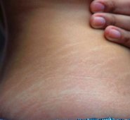 Las estrías es mejor prevenirlas, porque una vez se han formado es muy difícil eliminarlas totalmente. Internet | Referencial