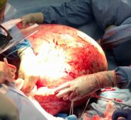 El tumor "la estaba matando lentamente", comentó Bouley el jueves durante una conferencia de prensa en el hospital. Internet