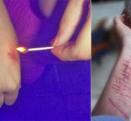En EEUU aproximadamente una de cada cuatro chicas adolescentes intenta hacerse daño, cifra que entre los varones es de uno de cada diez, según el estudio del Centro de Política para la Infancia y la Familia de la Universidad de Duke. Psicologos-malaga.com