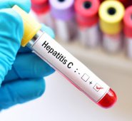 La hepatitis C mata cada año a 400.000 personas, mientras que 71 millones son portadoras crónicas del virus. Cortesía