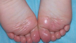 Se recomienda diariamente bañarse los pies con agua y jabón antiséptico. Internet