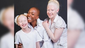 La cucuteña Belky Arizala apoyará a la fundación albinos de corazón. Instagram