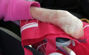 La Epidermólisis Bullosa Distrófica produce serias heridas en la piel que son profundamente dolorosas, incluso desprendiéndose. Colprensa