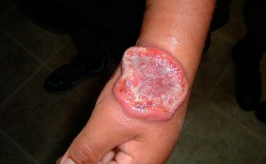 Niños y adultos, sin distinción, son perjudicados por la enfermedad. Este año van 23 casos en Chinácota, 25 en Arboledas, 15 en Bochalema, 11 en Tibú y 7 en Cucutilla. Internet | Referencial