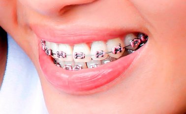 El éxito de la ortodoncia depende de la constancia e higiene del paciente. Internet