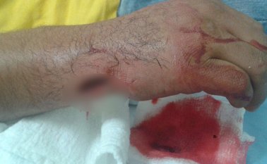 Así quedó la mano izquierda del promotor del espacio público agredido por una vendedora ambulante. La herida, por suerte, no comprometió tendones. Cortesía