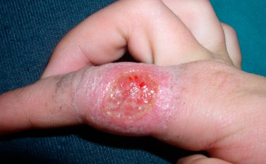 Las autoridades del departamento señalaron que también han sido registrados 8 casos procedentes de Cesar, Antioquia, Bolívar, Caquetá, Santander, Tolima y Vaupés. Archivo