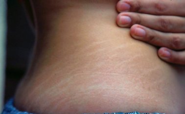 Las estrías es mejor prevenirlas, porque una vez se han formado es muy difícil eliminarlas totalmente. Internet | Referencial