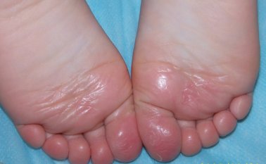 Se recomienda diariamente bañarse los pies con agua y jabón antiséptico. Internet