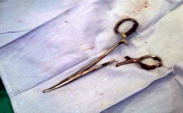 Un par de tijeras de 15 centímetros de largo "olvidadas" hace casi dos décadas AFP