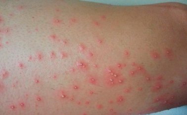 Aunque no tiene consecuencias ni deja secuelas, sí deja una importante recomendación para que la ciudadanía sea precavida con su aseo personal. Internet | Referencial