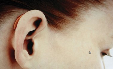 Más de 5 % de la población mundial (360 millones de personas) padece pérdida de audición discapacitante, dice la OMS Colprensa