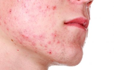 Claso de acné severo. Internet