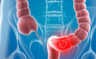 Para reducir el riesgo de sufrir esta enfermedad es importante mantener un peso adecuado, hacer actividad física, comer frutas, verduras y fibras, no fumar y moderar el consumo de alcohol. Internet | Referencial