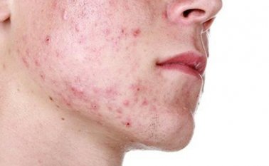 La preocupación de los expertos radica en que no es atendida en la debida forma por el sistema de salud y deja en el paciente graves secuelas físicas y emocionales. Colprensa