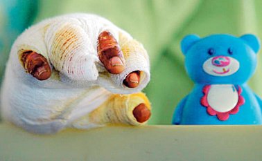 En 20 de los casos ha sido necesaria la amputación de alguna de las partes del cuerpo. Colprensa