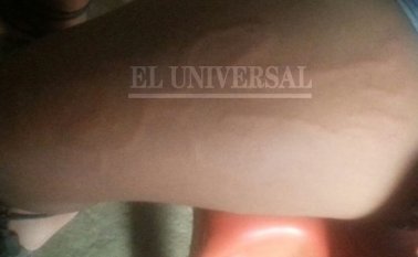 La muñeca que le salió a la niña en la pierna se movía dentro de la pierna y bailaba al ritmo de la música que salía de una vivienda vecina. El Universal