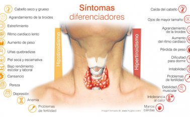 La población más afectada por el hipotiroidismo son las mujeres mayores de 40 años y los hombres mayores de 60 años. Colprensa