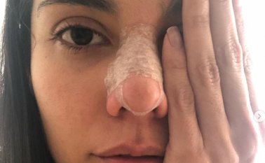 Moreno denunció una agresión física por parte de su novio, el actor Alejandro García, en la que le fracturó la nariz y la órbita del ojo izquierdo. Tomada de Instagram