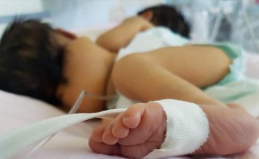 Están realizando estudios y análisis para definir cómo afectaría la salud de la niña formada al separarla de su hermana. Twitter