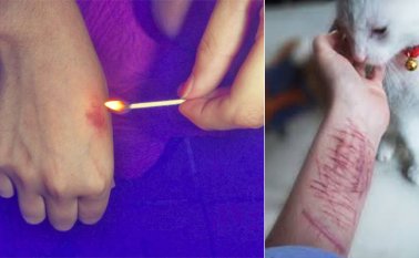 En EEUU aproximadamente una de cada cuatro chicas adolescentes intenta hacerse daño, cifra que entre los varones es de uno de cada diez, según el estudio del Centro de Política para la Infancia y la Familia de la Universidad de Duke. Psicologos-malaga.com