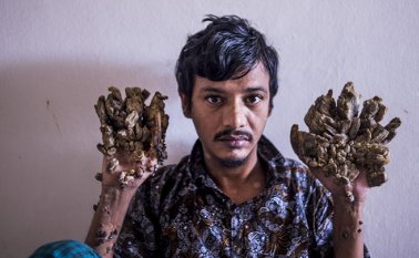 El caso de Abul Bajandar se conoció en todo el mundo durante su primer ingreso en el hospital en Bangladés en 2016. AFP