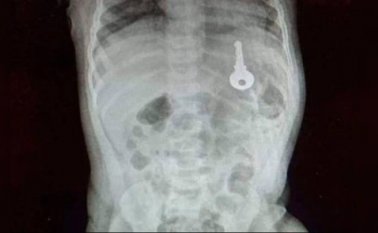 La endoscopia digestiva practicada al menor duró 20 minutos y permitió, además, establecer que este no sufrió ningún daño en su cuerpo. @ElUniversalCtg