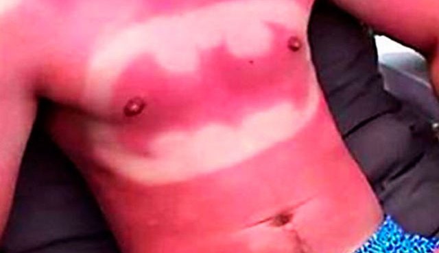 Así queda la piel luego de exponerse varias horas al sol. Internet