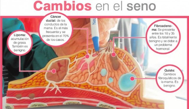 La prueba para los genes Brca1 y Brca2 es un examen de sangre que puede indicar si usted tiene un mayor riesgo de padecer cáncer. El nombre Brca proviene de las dos primeras letras del cáncer de mama en inglés (breast cancer). La Patria