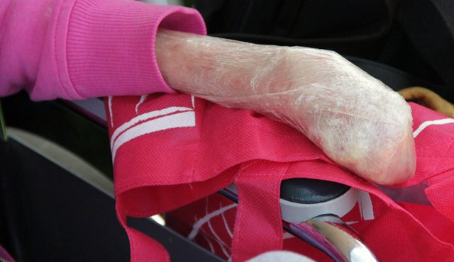 La Epidermólisis Bullosa Distrófica produce serias heridas en la piel que son profundamente dolorosas, incluso desprendiéndose. Colprensa