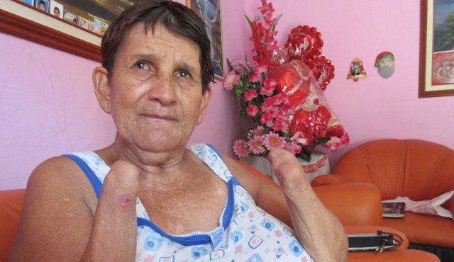 Miriam García, quien perdió sus manos hace dos años cuando intentaba manipular pólvora en su casa del barrio Cuberos, aconsejó a los papás que por el bien de sus hijos menores no les compren estos productos pirotécnicos en las fiestas decembrinas.
Orlando Carvajal