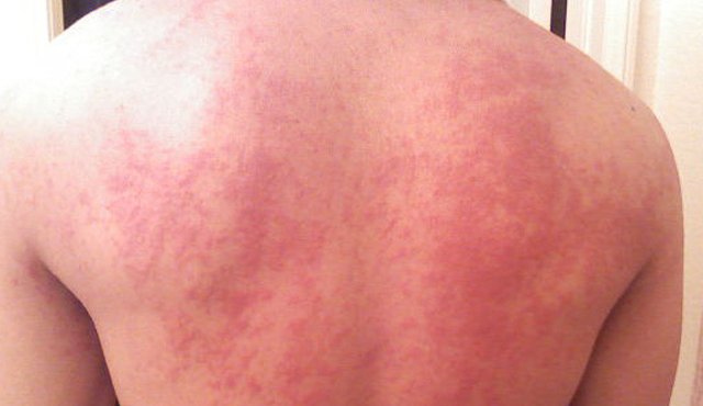 Brote generado por el zika. Internet