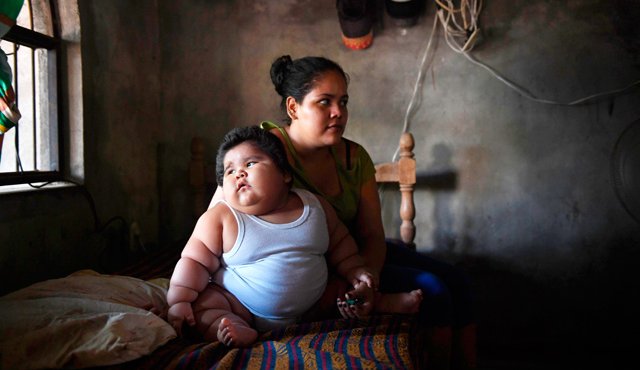 El bebé tiene hígado graso, pulmón graso y corazón graso, según la médico Silvia Orozco. AFP