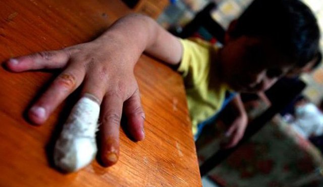 Los niños son quienes resultan mayormente afectados ante la manipulación de la pólvora. Colprensa