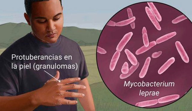 Esta es la bacteria que produce la lepra. Internet