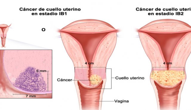Cáncer de cuello uterino. Internet
