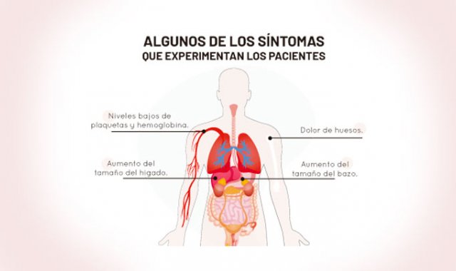 Ilustración de síntomas de la enfermedad de Gaucher. La Opinión